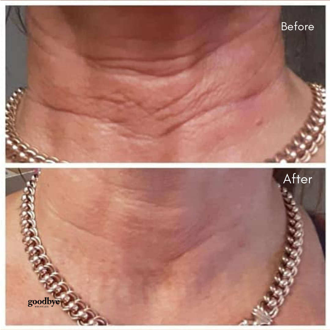 Neck Smoothing Mask